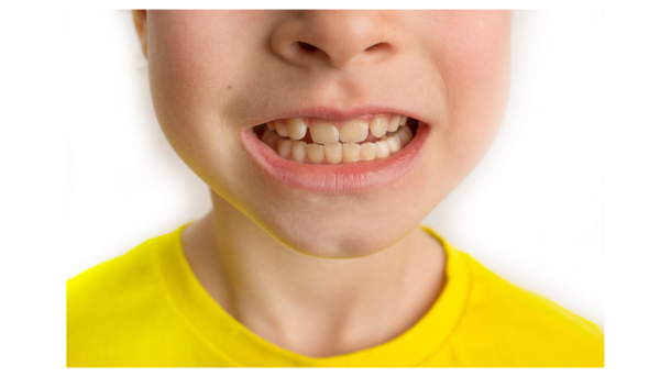 occlusione dentale