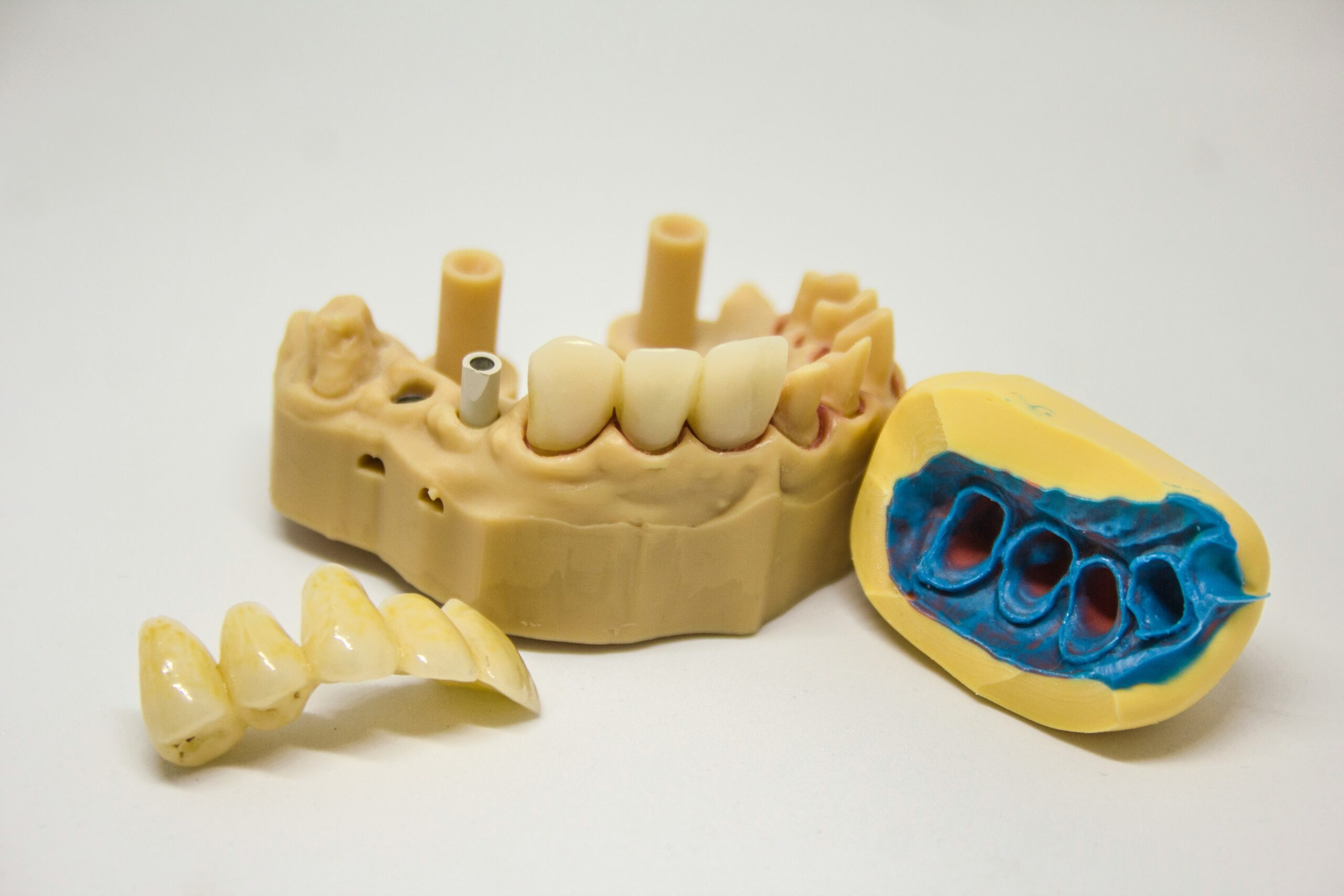 corone dentali - come viene applicata