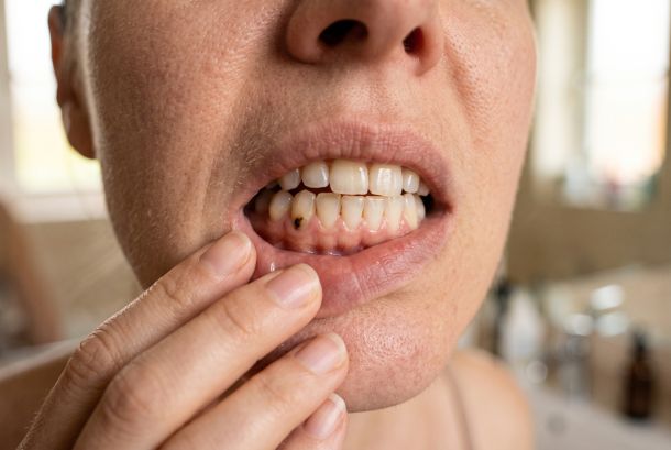 Close-up of a person's mouth as they pull down their lower lip, revealing teeth with a small brown cavity on a lower front tooth.